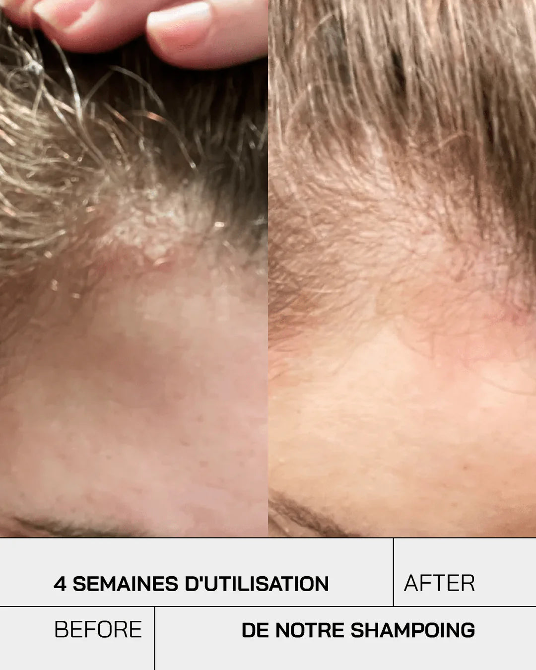 Touché Shampoing Anti-Psoriasis