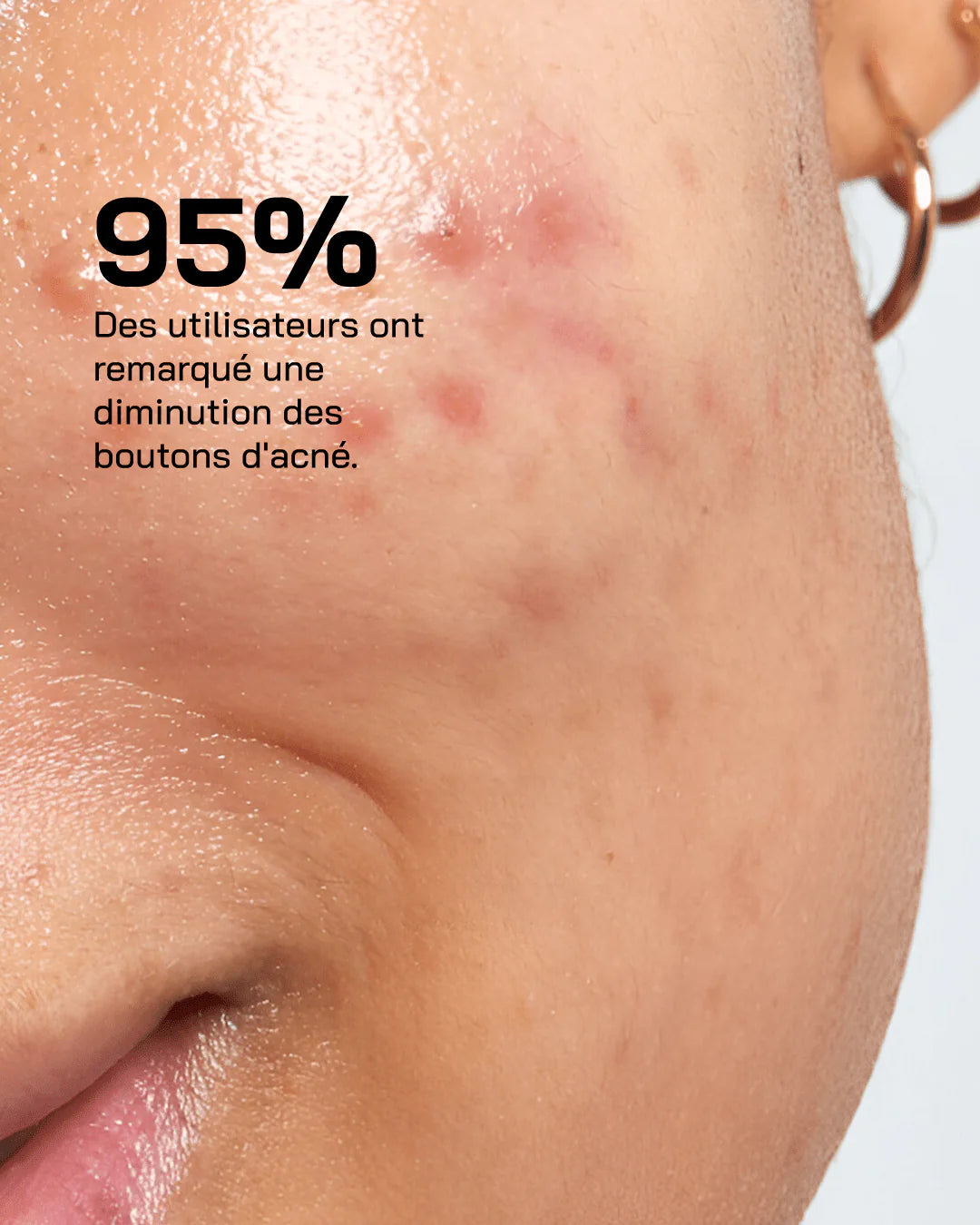 Touché Anti Acné